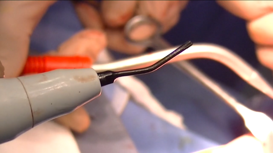 Fig. 2 - Notare la concavità dell’inserto che, in base all’angolazione può essere utilizzato in più posizioni.