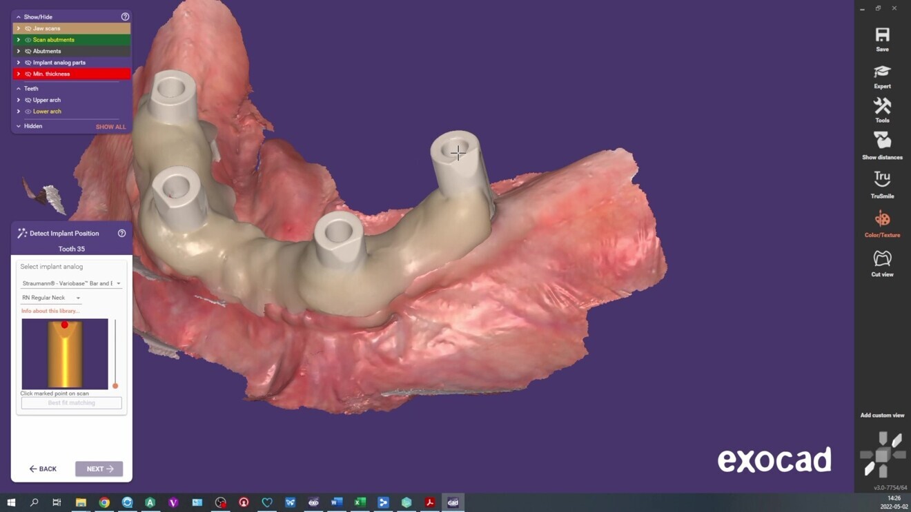 Fig. 5: Intra-oral scan of the implant positions.