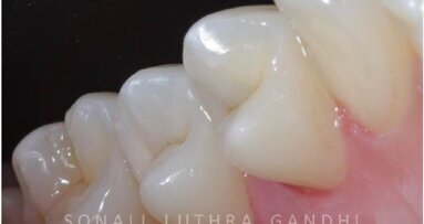 Management of proximal posterior lesions: A case report