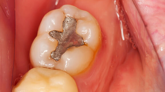 Three African countries to phase down dental amalgam use