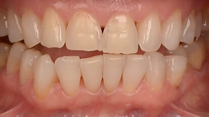 Fig. 1: The patient had worn teeth, visible abrasion, erosion and crowding in the mandibular arch.