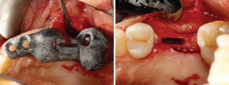 Fig. 5 - Inserimento in situ della dima chirurgica e sito preparato per accogliere l’impianto REX progettato.