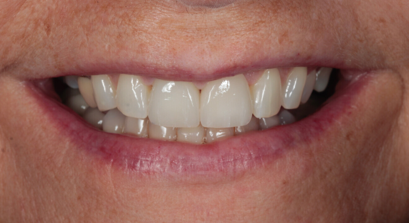 Fig. 16: 2021—the patient’s teeth 17 years later thanks to interceptive treatment with alignment and direct edge bonding according to the Dahl principle to minimise the amount of damage.