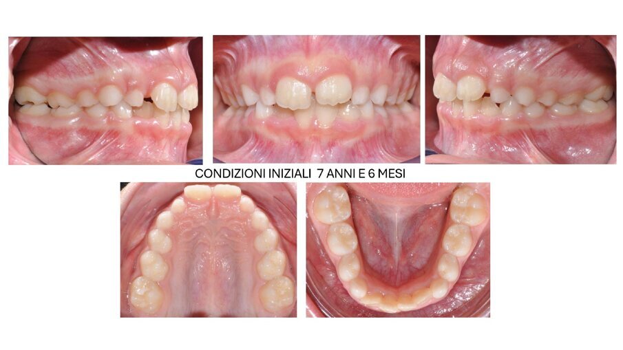 Fig. 1_Fotografie occlusali pretrattamento. 