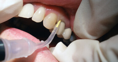Pest control in gums gardening: Locally applied antimicrobials as adjuncts to nonsurgical periodontal therapy