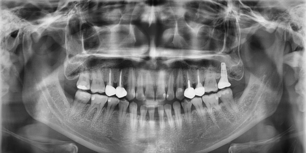 Fig. 3: Initial panoramic radiograph.