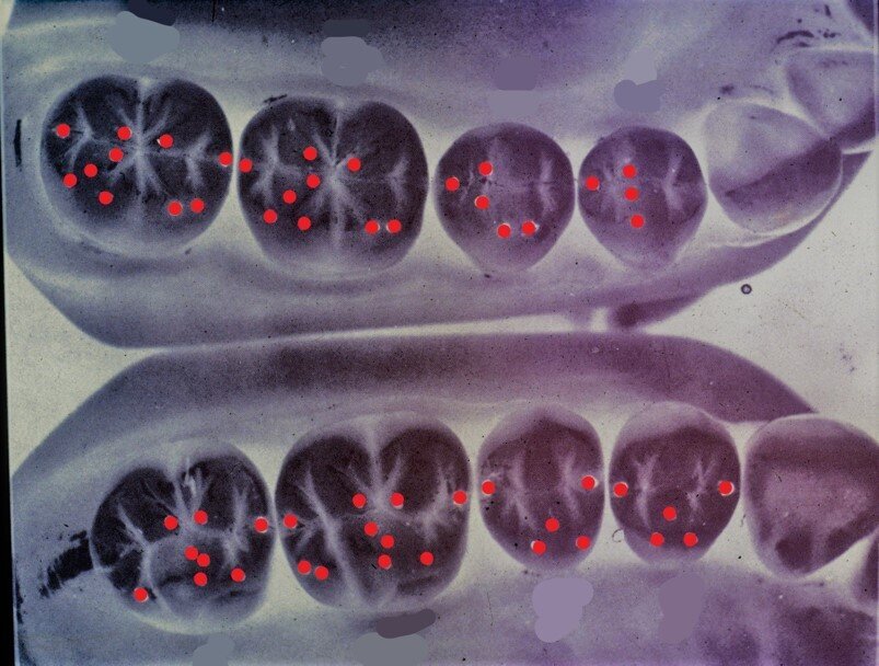 Fig. 2 - I 112 punti di contatto secondo Lundeen: Modellazione di Lundeen di tipo 1=104 punti di contatto; Modellazione di Lundeen di tipo 2=112 punti di contatto.