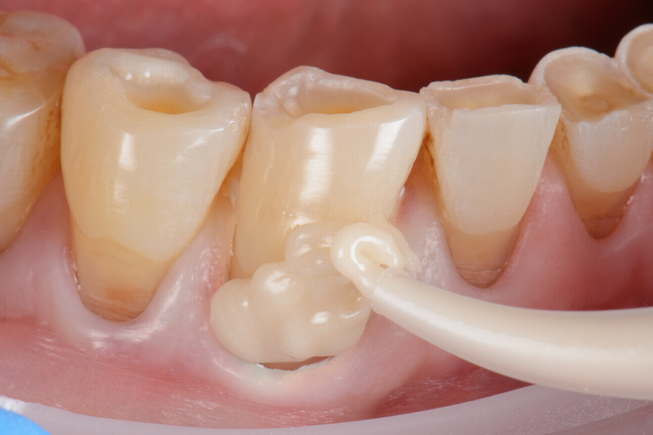 Fig. 3a : Une lésion cervicale est restaurée au moyen d’un verre hybride. a) Mise en place d’EQUIA Forte HT, 