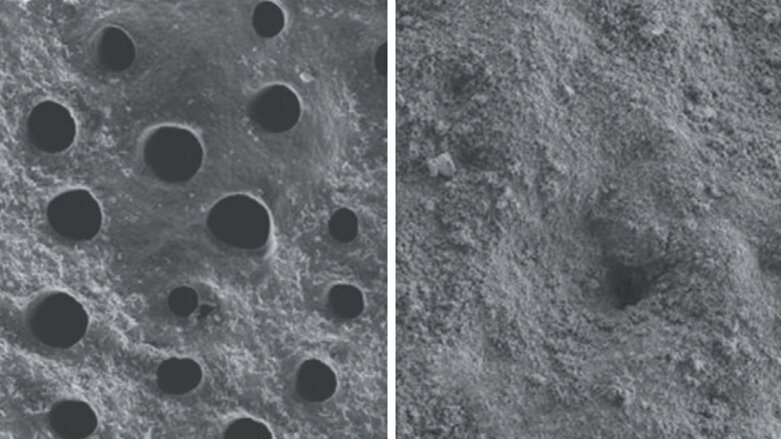 Hloubková obnova skloviny – zmírnění citlivosti zubu již po 1. použití, klinicky prokázáno