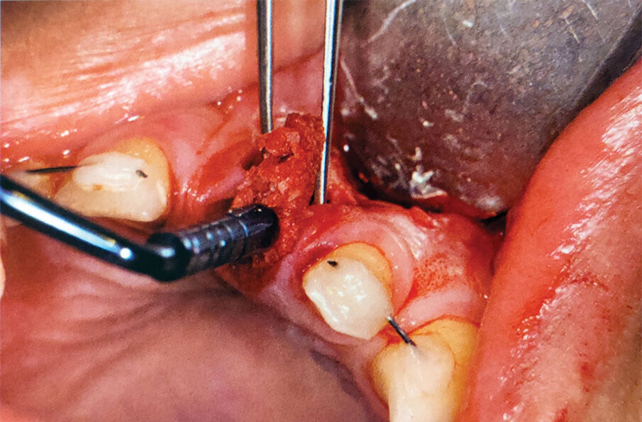 Fig. 3: Voids between the implant being placed and the extraction socket walls are filled with ‘gummy bone’ prior to site closure.