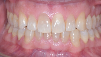 Nivellement adéquat de la courbe de Spee – Un facteur essentiel du traitement de la supraclusion par aligneurs