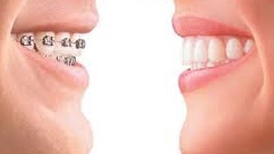 Σταυροειδής σύγκλειση