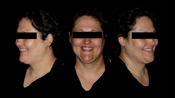 One-year follow-up of Straumann Fast Molar Solution in bilateral maxillary premolars