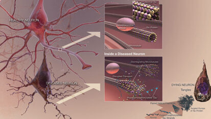 Alzheimer’s, cognitive decline linked to periodontal disease