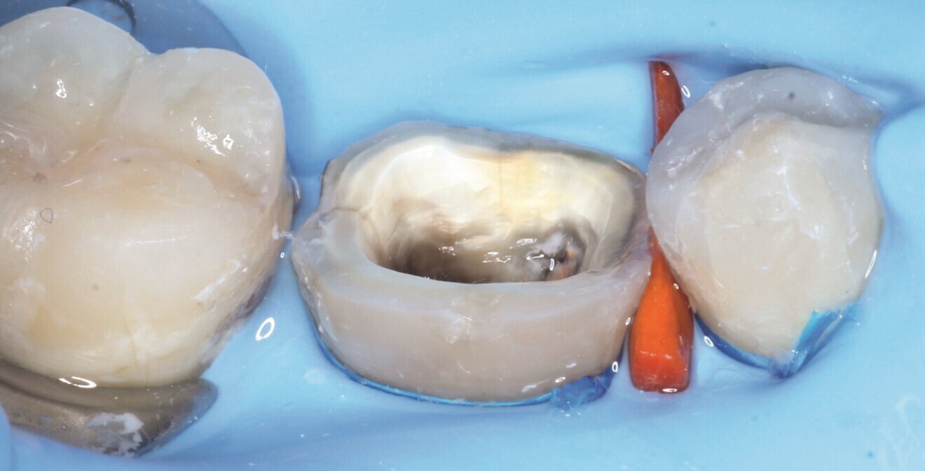 Fig. 6: Occlusal view of the pulp chamber and cavity after preparation for the milled endocrown. 