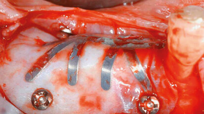 Procedura di incremento osseo verticale con tecnica GBR