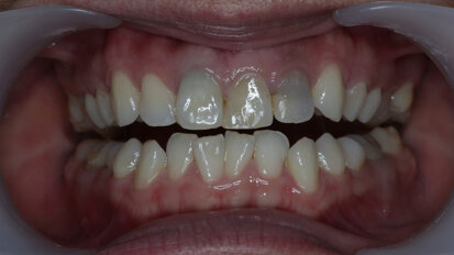 Functional and aesthetic temporisation with Dfab and Irix Max