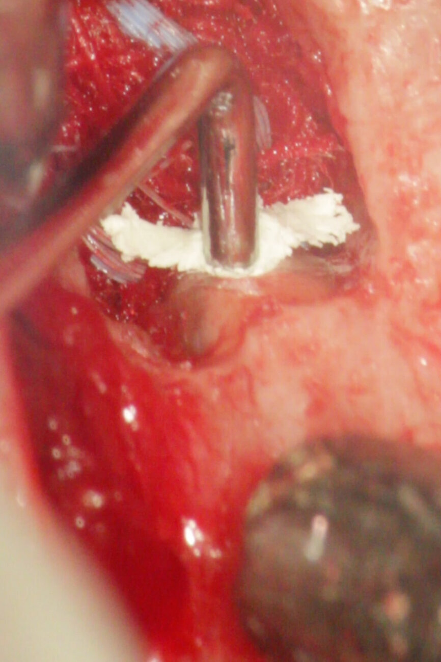 Fig. 4d: (a) Pre-op radiograph with a large periradicular lesion. (b) Periapical surgery. (c) MTA application with the MAP System and PD MTA White. (d) Condensation of the MTA with pluggers. (e) Mirror view of the root-end cavity filled with MTA. (f) Post-op radiograph showing the root-end filling.