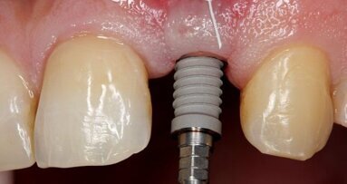 Implantologie-Update: Sofortversorgung und Platform Switching