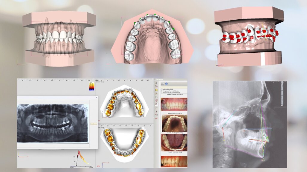 CBCT-based crown–root set-up supports anatomy-guided orthodontic planning