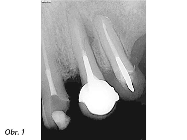 Periapikální léze implantátů a retrográdní periimplantitis