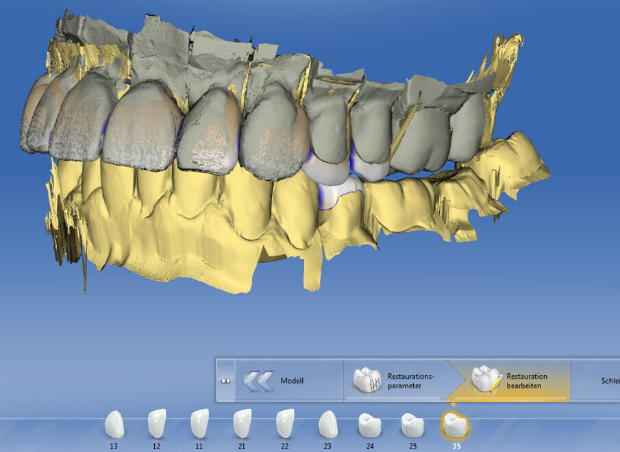 Fig. 9: Digital design of the restoration