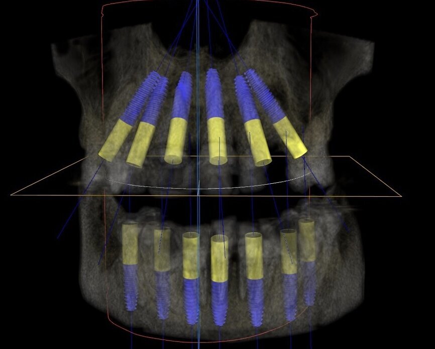 Fig. 6: Proposed treatment in CS 3D Imaging Software.