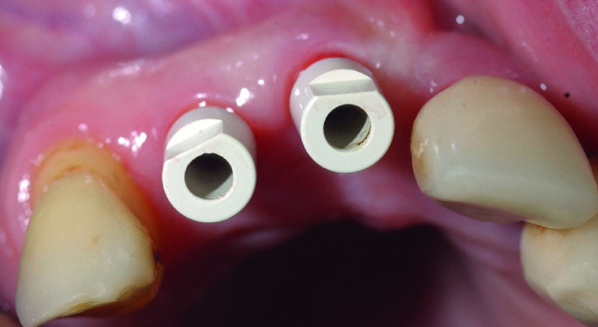  Figs. 11a & b : Vues cliniques et occlusales des scan bodies en place. Notez les positions et les axes obtenus, qui faciliteront les réalisations prothétiques définitives. 