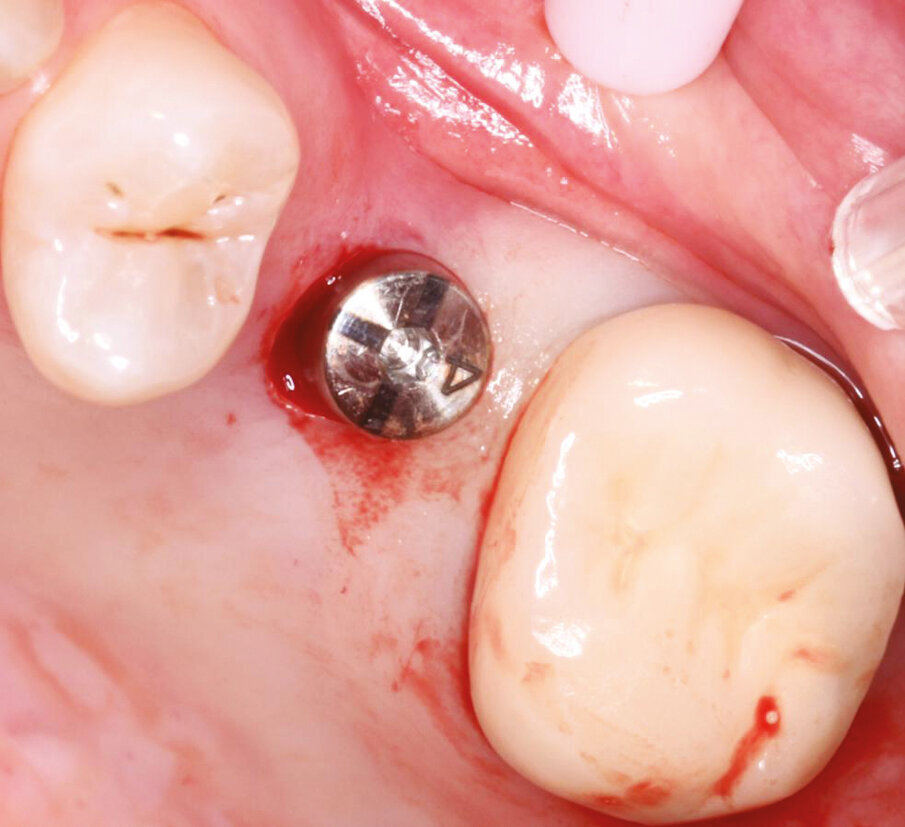 Fig.7: Axiom concept for healing cap selection to form transmucosal passage for excellent final aesthetics. 