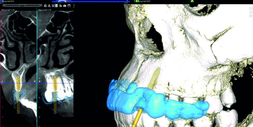 Fig. 4: Digital implant and surgical guide planning in Planmeca Romexis software.
