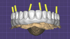Efficient production of a hybrid implant-supported full-arch prosthesis