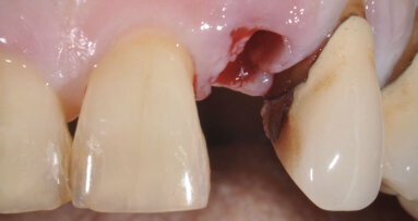 Sostituzione immediata mediante impianto e restauro immediato in sede incisivo laterale superiore