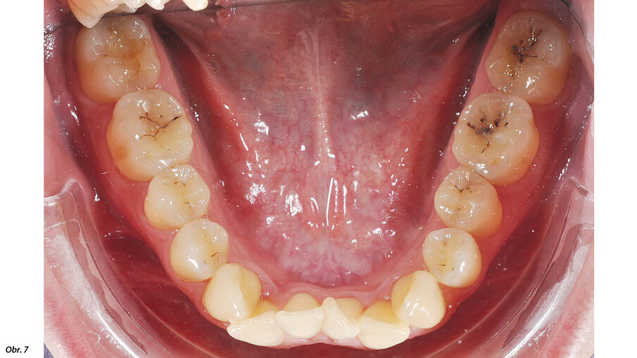 Horní řezáky jsou mírně protrudované, dolní řezáky mírně retrudované.