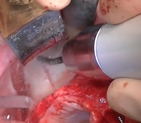 Fig. 5a - L’inserto è stato progettato per essere manipolato delicatamente senza alcun tipo di forza da parte dell’operatore.