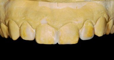 Amélioration du plan de traitement esthétique et de la communication grâce au mock-up diagnostique