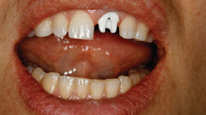 Inovativní technologie ve zhotovování náhrad na implantáty – budoucnost je tady již dnes