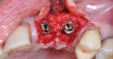 Interview: Periodontitis and peri-implantitis in implant dentistry