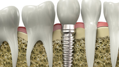 Implantate: Strom tötet Bakterien ab