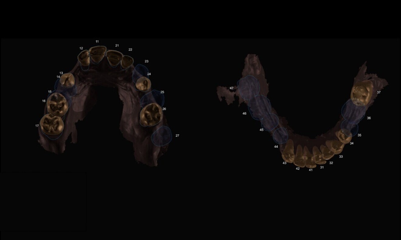 Fig. 10: Digital treatment planning was performed.