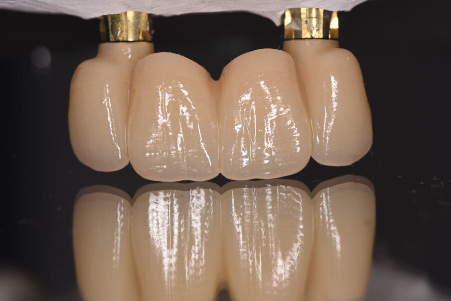 Fig. 27_Visione vestibolare del provvisorio sugli impianti con rispetto vestibolare dell’emergenza coronale nel riguardo del tunnel mucoso.