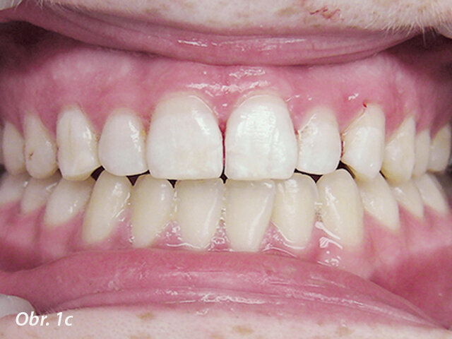 Obr. 1b, c: Po připojení obou fragmentů byl podél lomné linie vybroušen oblý schůdek, doplněn dalším kompozitem a zpolymerován na místě. To zvýší sílu spojení a lépe zakryje lomnou linii.