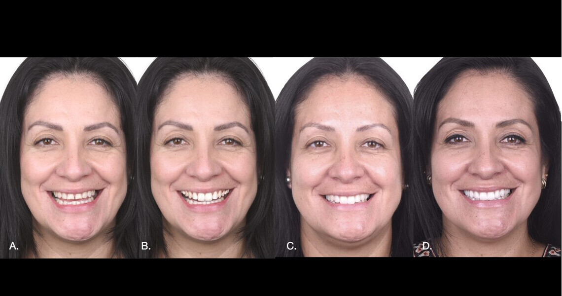 Figs. 9a–d: Full-face views demonstrating the predictability of the digital workflow. Initial situation (a). Digital mock-up (b). Physical mock-up (c). Final restorations (d).