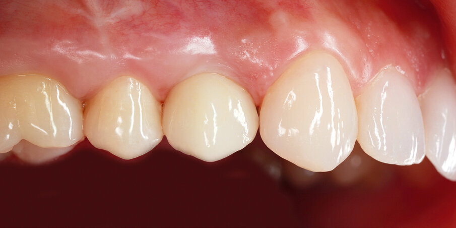Fig. 38: The completed restoration in 2012: a pleasing result.