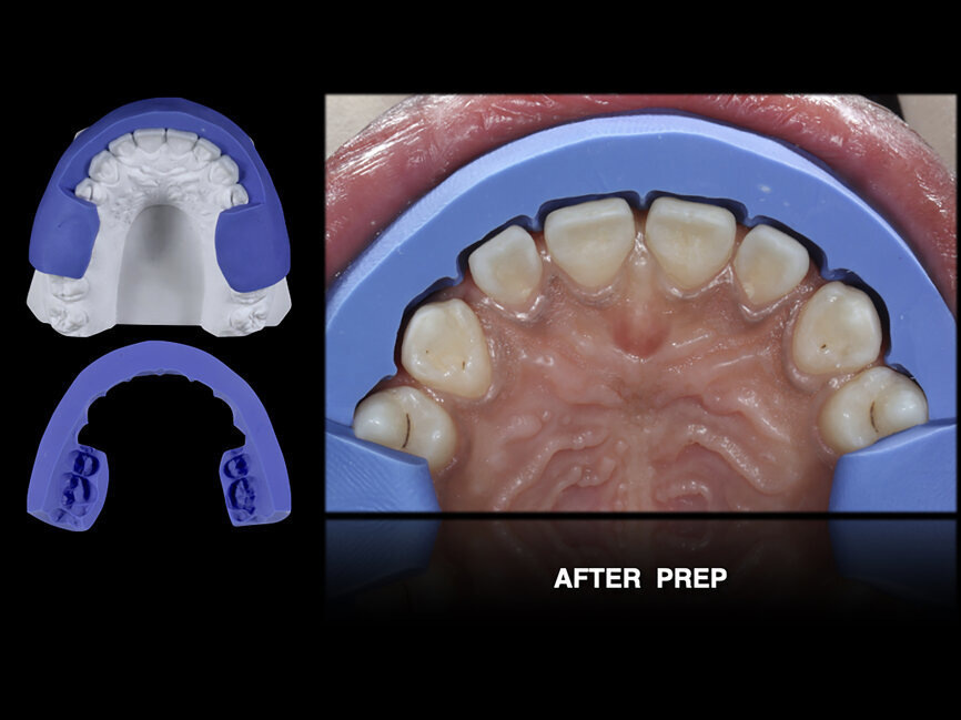 Fig. 57: Silicone index used to check facial reduction.