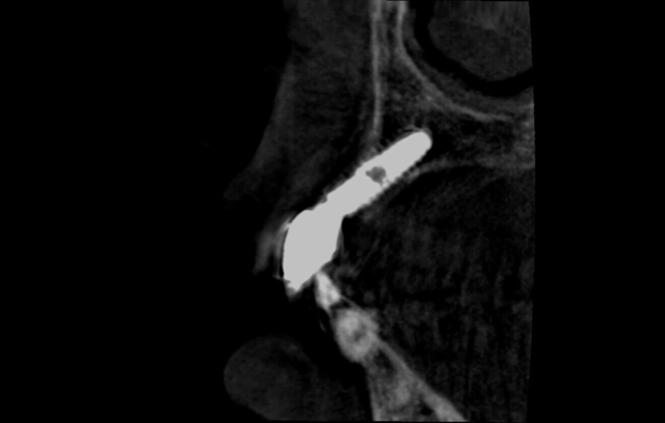 Fig. 2: CBCT evidence of labial implant malposition and bone loss.