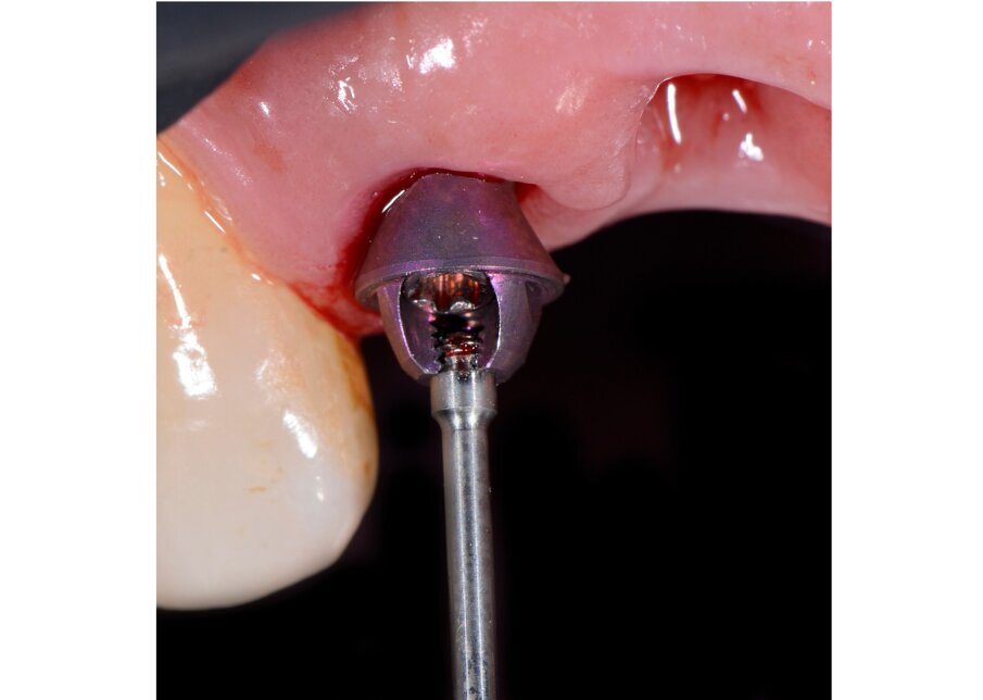 Fig. 58 - Alloggiamento SRA sul 1.2. 