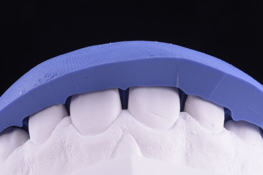 Fig. 36: Sectioned silicone key on the plaster model for laboratory
reduction.