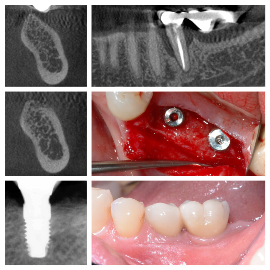 Fig. 5_Elemento di ponte 35 perso e deficit in zona 36, controllo a 16 mesi dal carico.