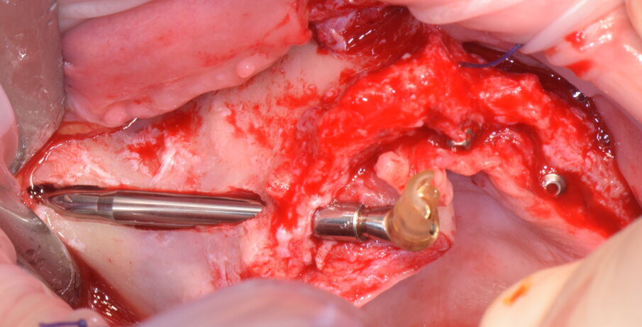 Figg. 24-26 - Inserimento implantare in emiarcata destra.