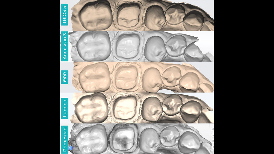 Fig. 4 - Scansioni monocromatiche elaborate sulla base della stessa preparazione dentale, visualizzate in anteprima nel software nativo dello scanner. TRIOS 5 (a). Aoralscan 3 (b). Medit i900 (c). ITero Lumina (d). CEREC Primescan (e).